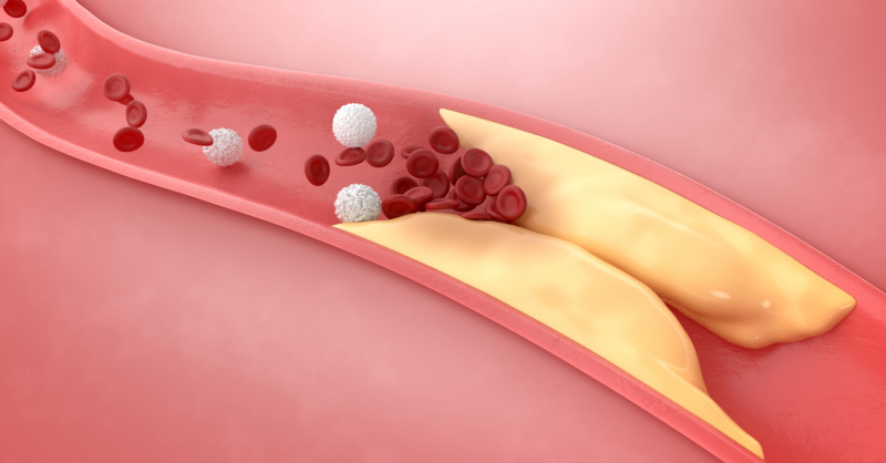 Kerbi Guevara: tu experto en cirugía vascular - Error 404 - tratamientos arteriopatias coronarias